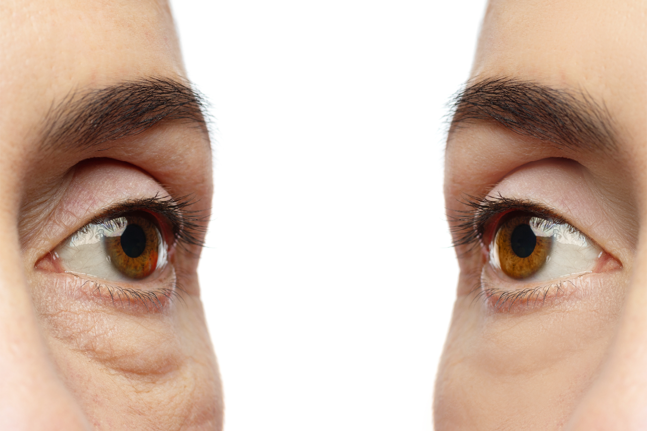Image Perfect Laser for Your Blepharoplasty