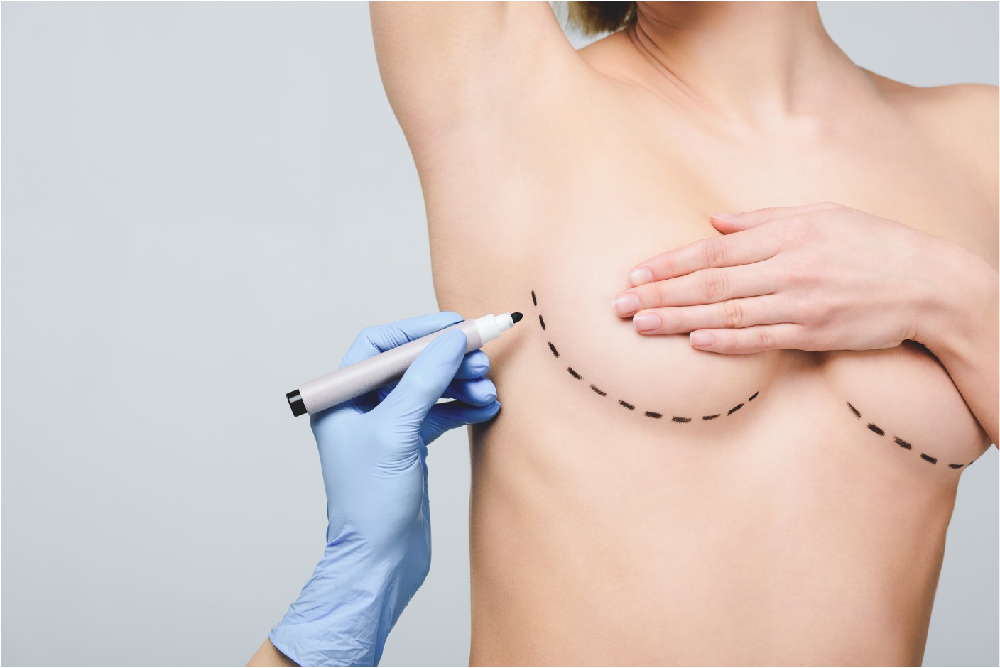 fat transfer to breast before and after