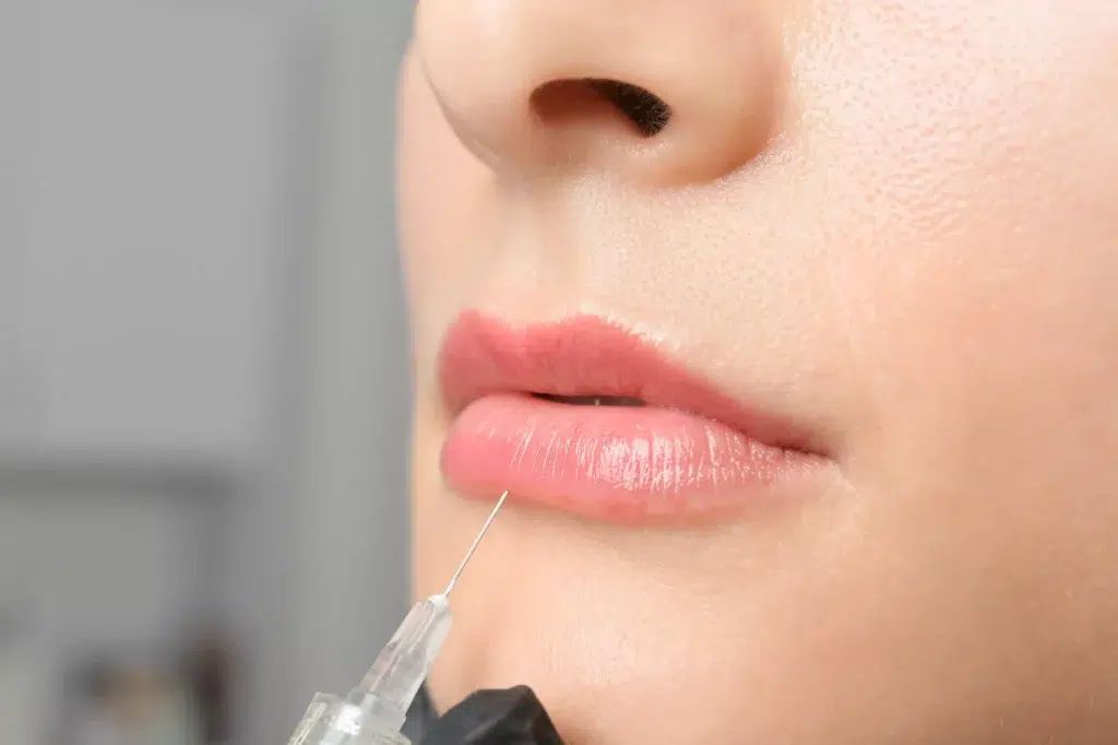 Lip Filler Treatment Process