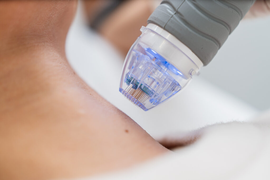 Close-up of a person getting a microneedling treatment