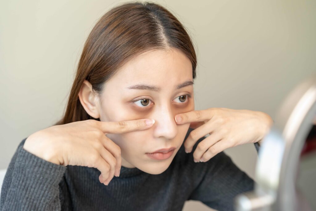 Woman needing professional treatments for tired eyes